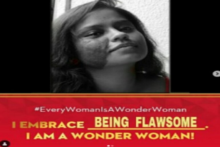 This image depicts a woman with burns on her face and hashtag of the trend in text
